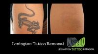 Lexington Tattoo Removal image 2